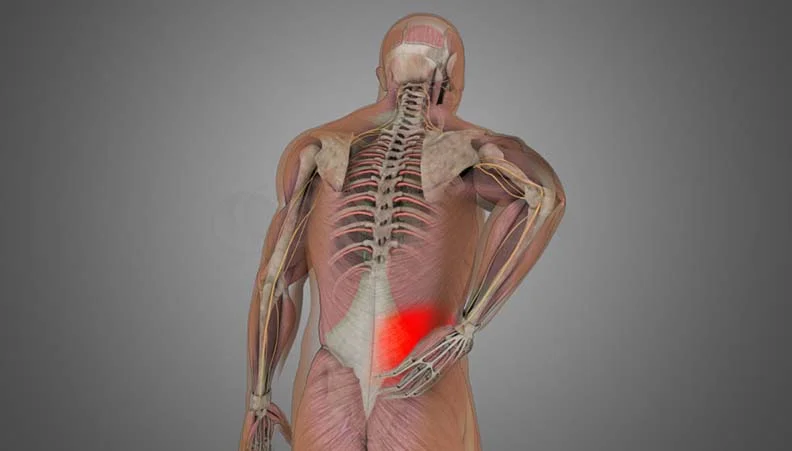 Back Sprain and Back Sprain Treatment