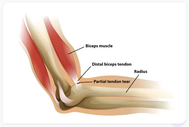 Bicep Sore Near Elbow