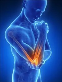 Causes of Lateral Epicondylitis