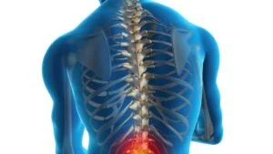 Diagnosing Back Sprain