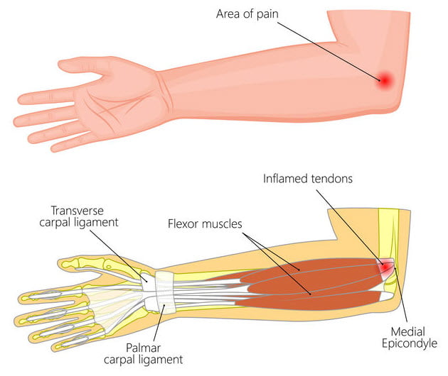 Golfer's Elbow: Signs, Causes and Treatment Options