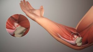 What Causes Inner Elbow Pain?