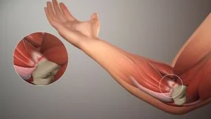 What Causes Inner Elbow Pain?