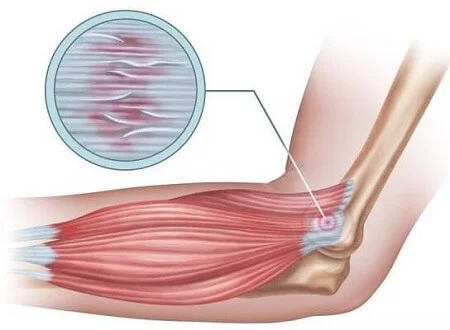 Lateral Epicondylitis