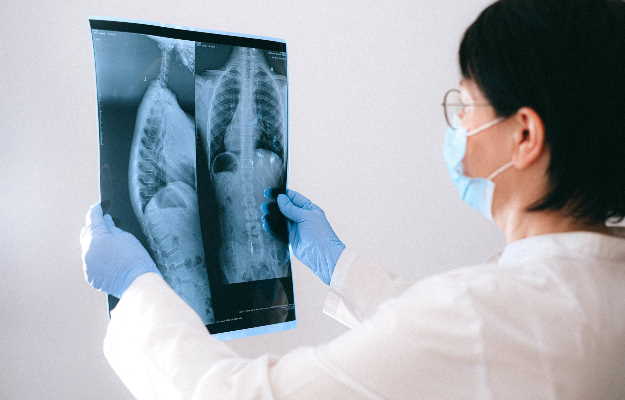 Pleurisy Back Pain: Causes, Symptoms, Treatment, and Prevention