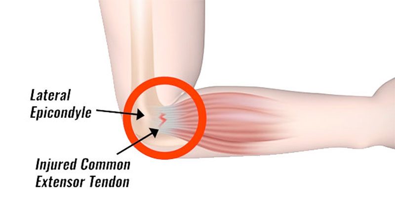 Tennis Elbow and Golfer's Elbow: Causes, Symptoms and Prevention