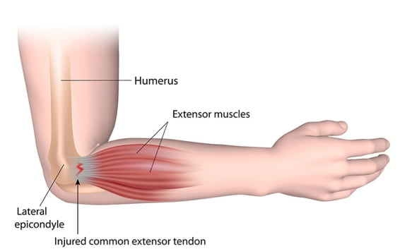Combating Tennis Elbow: A Comprehensive Guide to Treating Lateral Epicondylitis