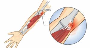 What Are The Main Causes Of Elbow Pain?