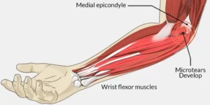 How Do You Treat Inner Elbow Pain?