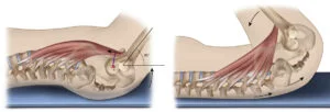 How Is Psoas Syndrome Diagnosed?