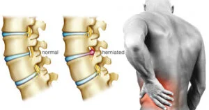 Where Is Discogenic Pain Located?