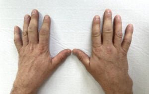 Understanding Rheumatoid Arthritis