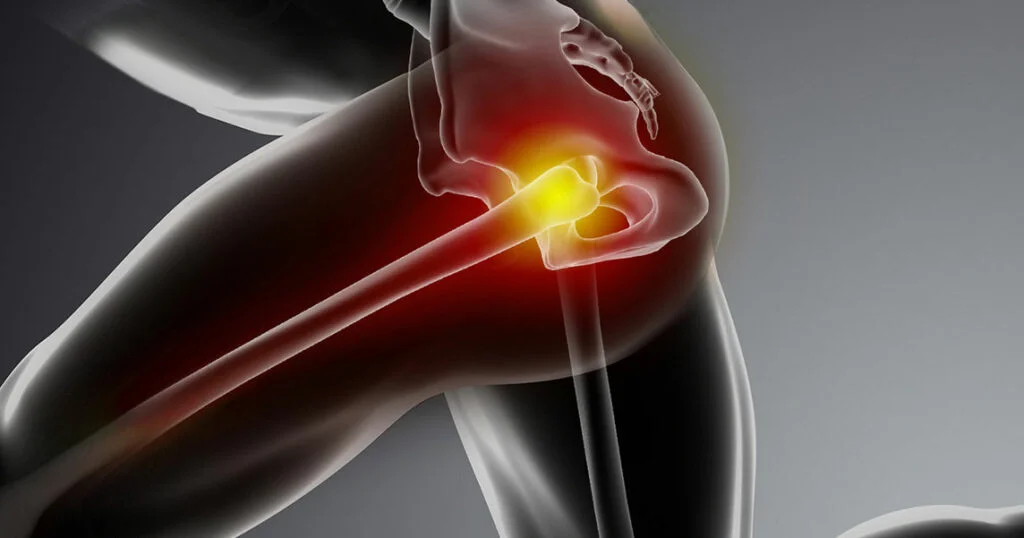 A Comprehensive Guide to Hip Impingement Treatment