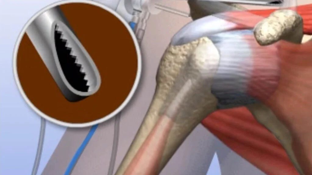 Acromioclavicular Joint Arthritis: Understanding, Treatment, and Management