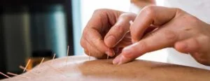 Acupunture