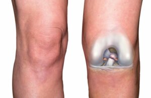 Benefits of Professional ACL Physical Therapy