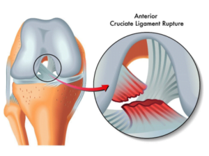 Post-Surgery Rehabilitation Phases
