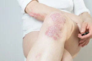 Causes of Psoriatic Arthritis in Knees