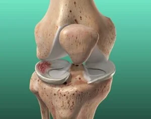 Causes of Torn Cartilage in the Knee