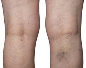 Deep Vein Thrombosis (DVT)
