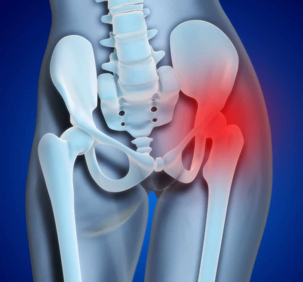 Hip Tendonitis: Signs, Causes, Treatment And Prevention