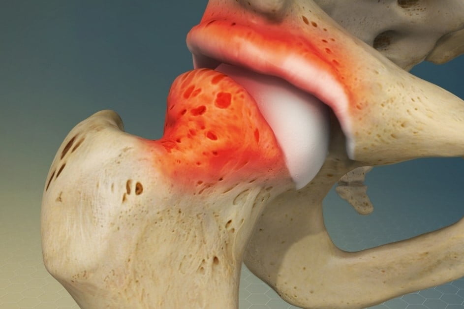 Femoroacetabular Impingement (FAI): Understanding, Treatment, and Living