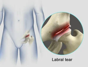 Can Hip Ligaments Be Repaired?
