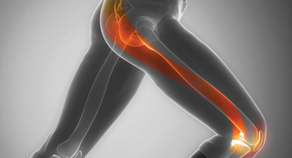 ITBS Knee Pain: What Is It, Causes And Treatments To Know