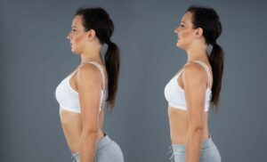 Long-Term Benefits of Physical Therapy for Scoliosis