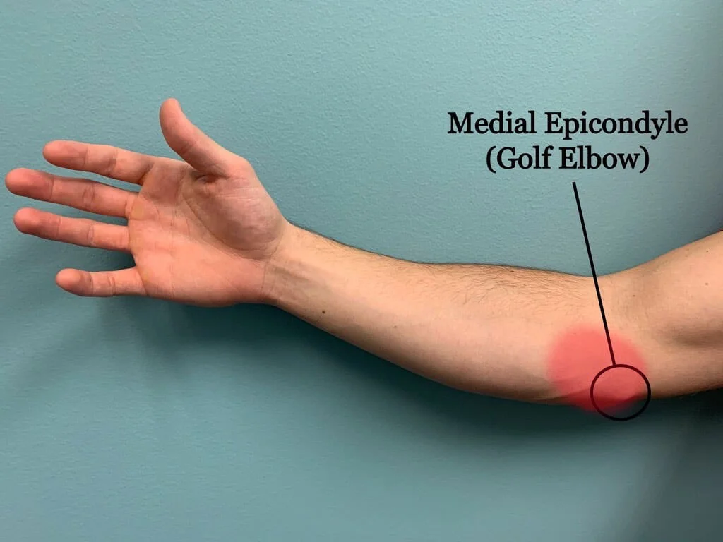Medial Elbow Pain - Causes, Treatments, and Prevention