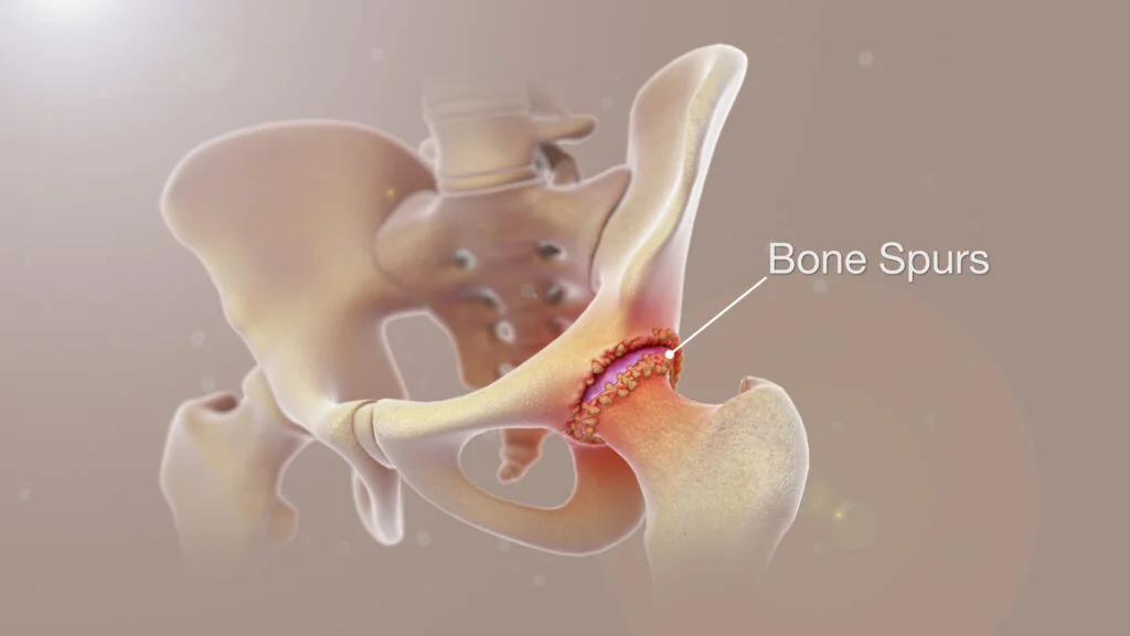 Dealing with Bone Spurs in the Hip: Understanding, Diagnosis, and Treatment