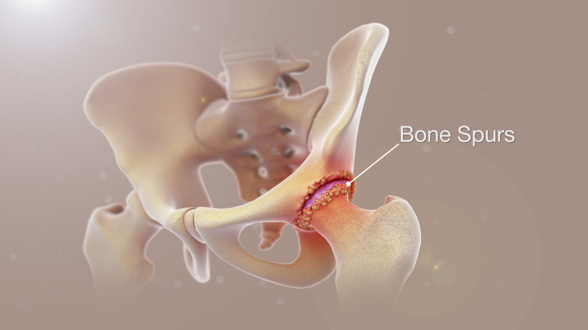 Dealing with Bone Spurs in the Hip: Understanding, Diagnosis, and Treatment