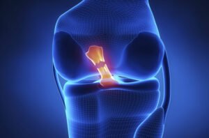 Causes of ACL Injuries
