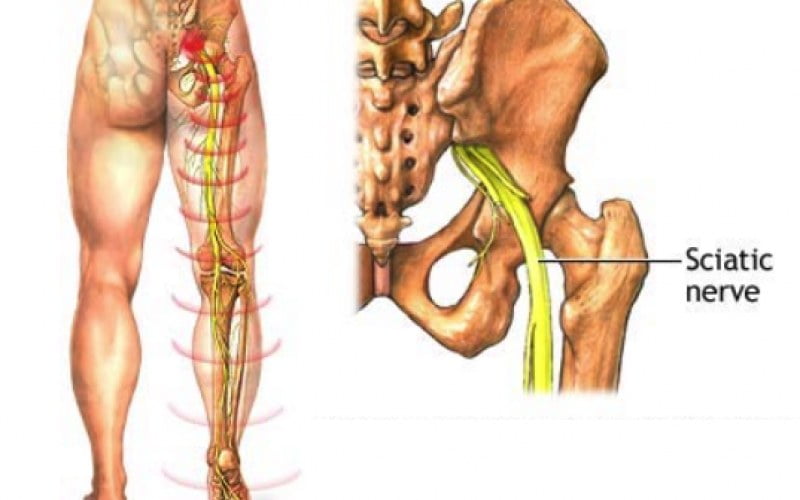 Understanding Sciatica Nerve: What Treatments Can help?