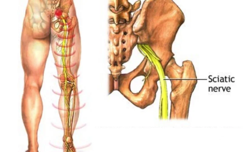 Understanding Sciatica Nerve: What Treatments Can help?