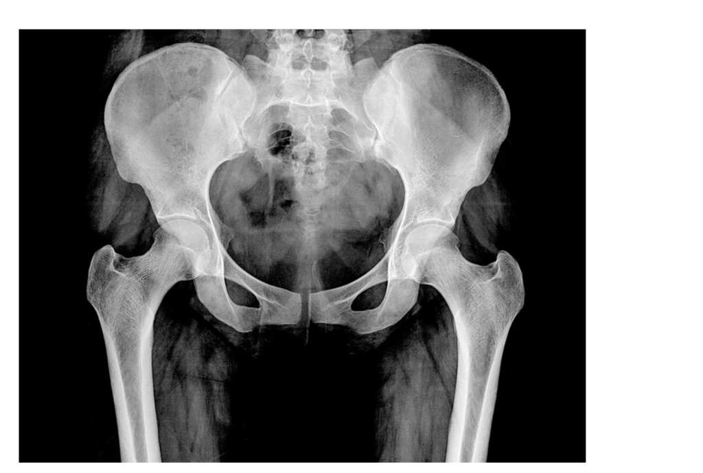 Bone Spurs In Hip: Symptoms To Know, Treatment And Tips