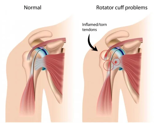 Shoulder Tendonitis