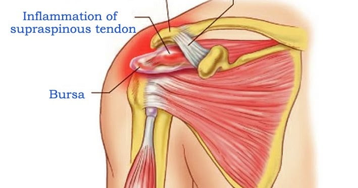 Supraspinatus Tendonitis Treating, and Preventing Shoulder Pain