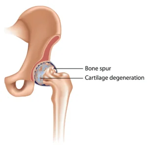Techniques of Physical Therapy for Hip Arthritis