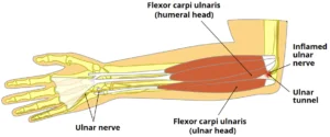 Understanding Cubital Tunnel Syndrome
