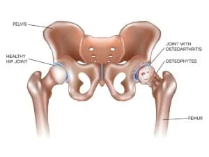 Understanding Hip Arthritis