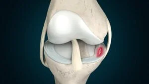 Understanding Meniscus Tears