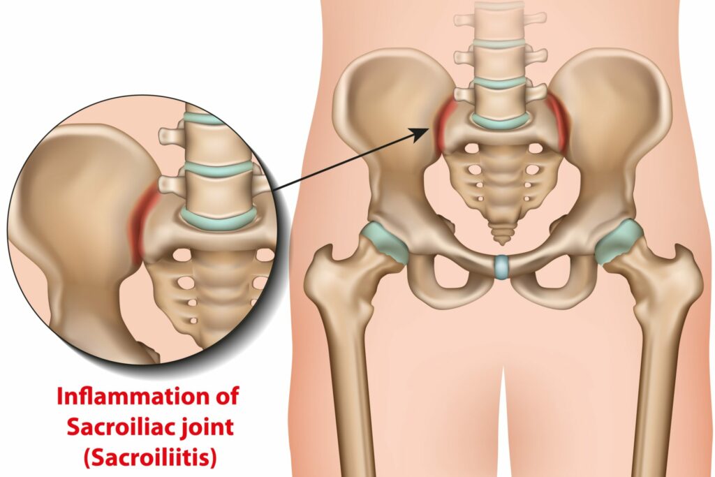 Understanding and Relieving Sacroiliac Joint Pain