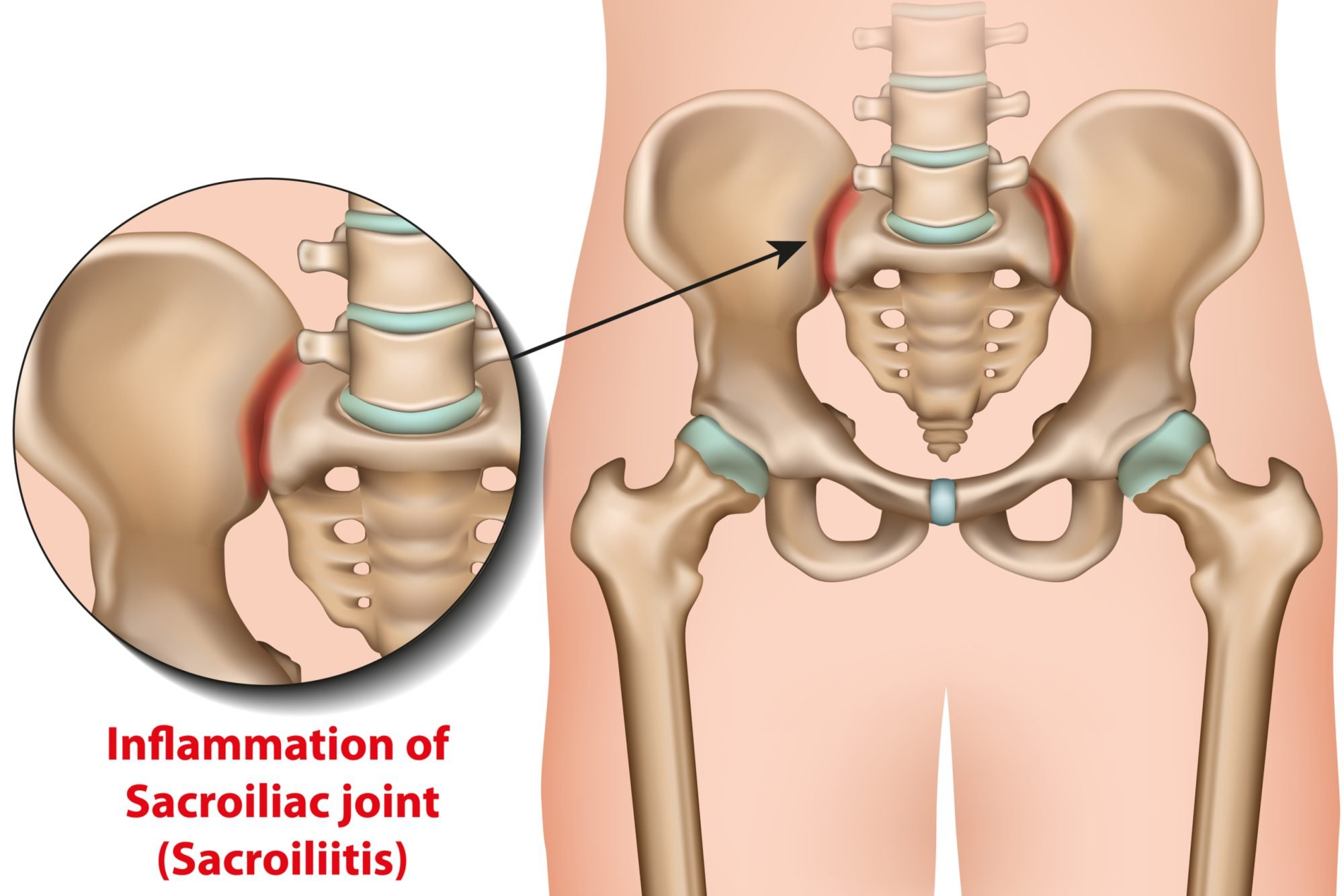 Understanding and Relieving Sacroiliac Joint Pain