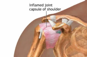 What is a Frozen Shoulder?