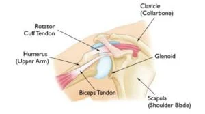 Understanding Bicep Tendonitis