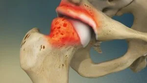 What Causes Hip Impingement?