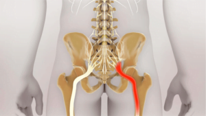 Can Sciatica Stop Bowel Movements?