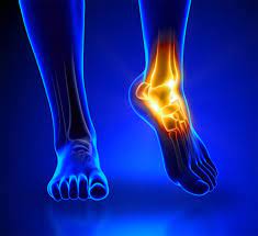 Understanding Tendonitis