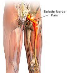 What Nerve Is Affected In Sciatica?